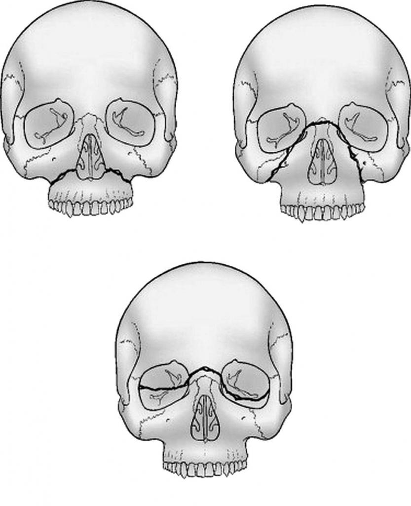 виды переломов Ле Форт