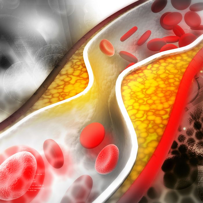 «Плохой» холестерин