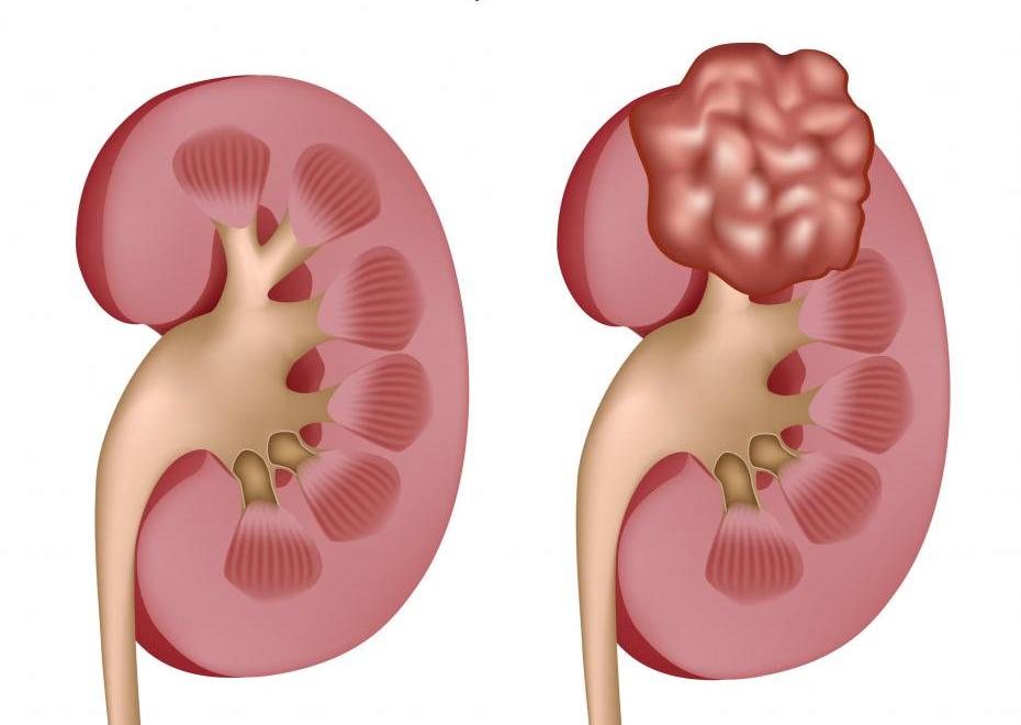 Субкапсулярная киста почки фото