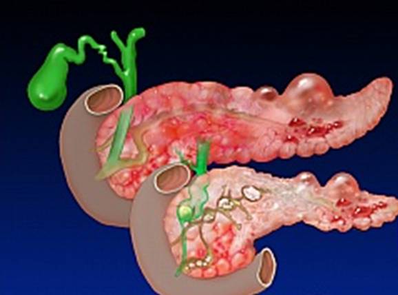 Паренхиматозный панкреатит это