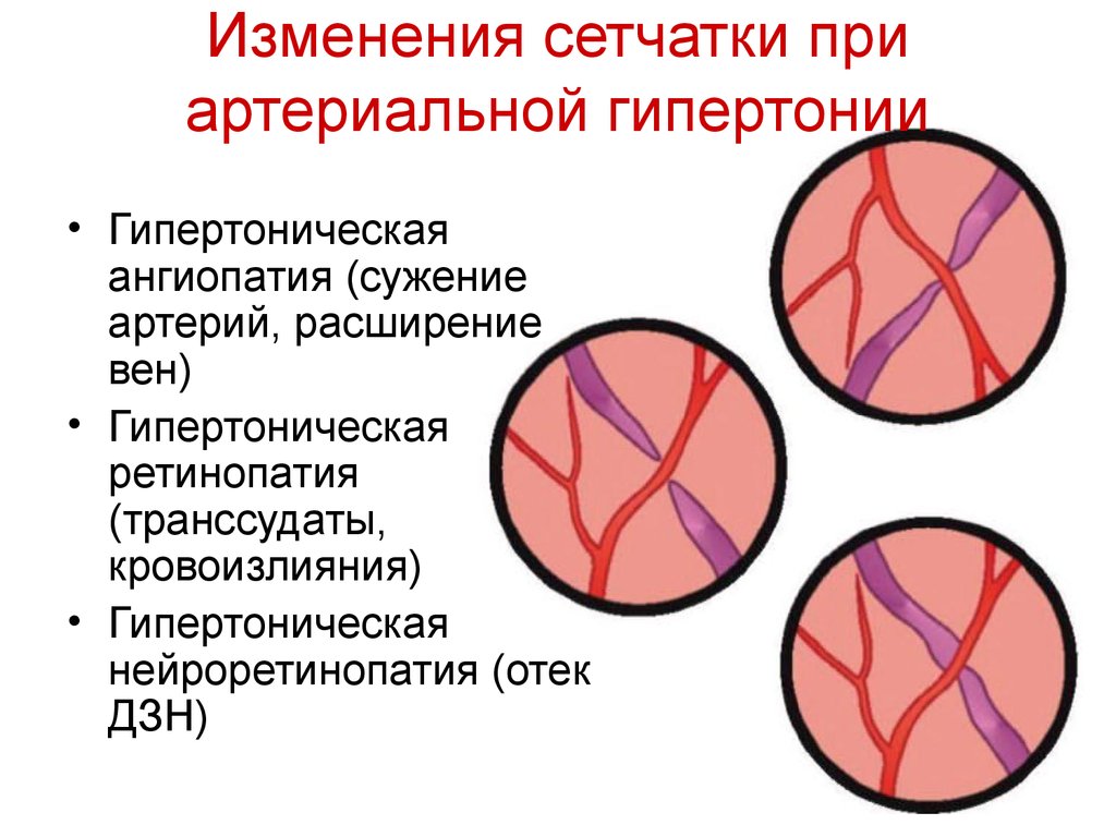 Глазное дно при гипертонической болезни - виды изменений