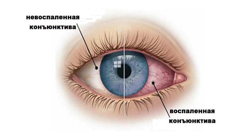 воспаленная и невоспаленная конъюнктива