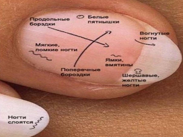 Ногтевой псориаз - симптомы