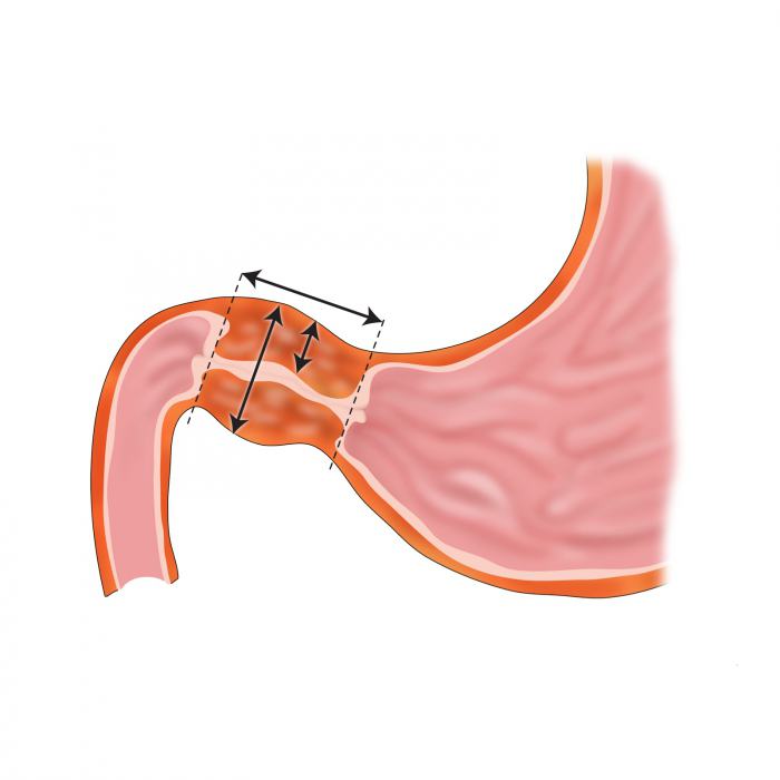 стеноз привратника желудка