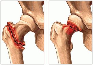 перелом шейки бедра у пожилых людей