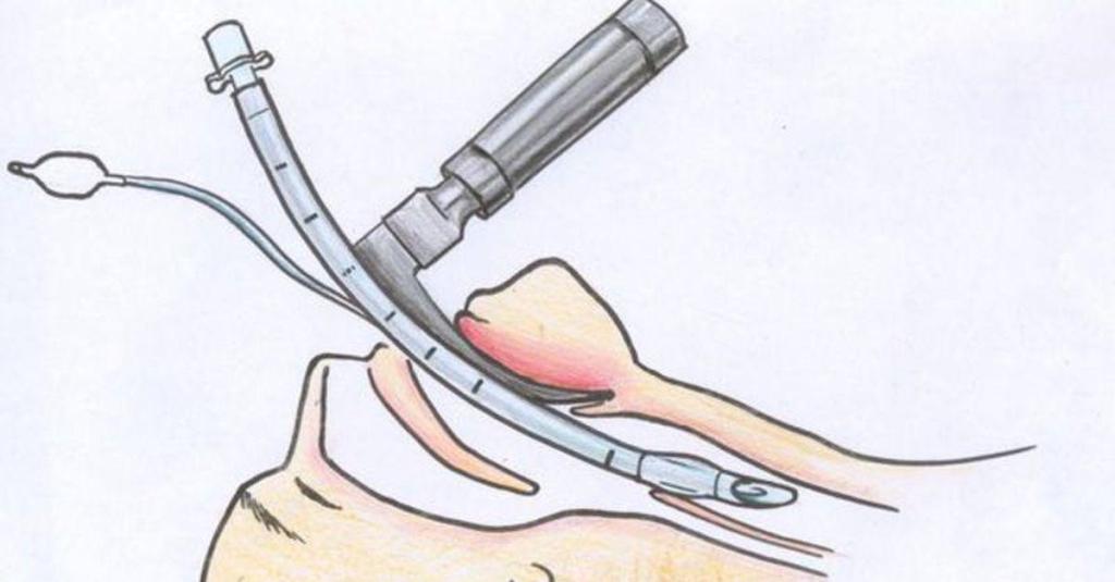 интубация трахеи