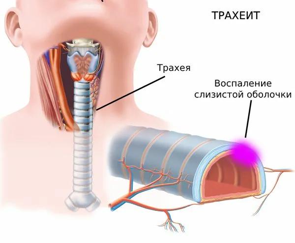 хронический трахеит