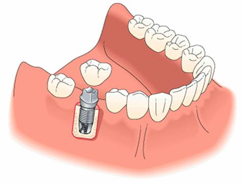 протезирование на имплантах