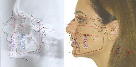 ортогнатическая хирургия