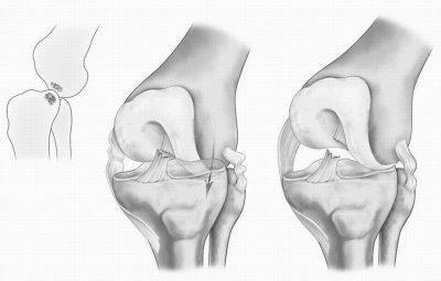 травма колена связки 