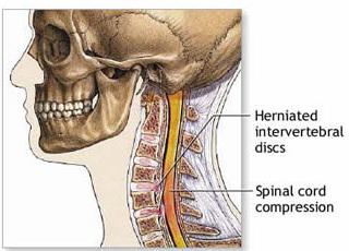 грыжа в шейном отделе позвоночника