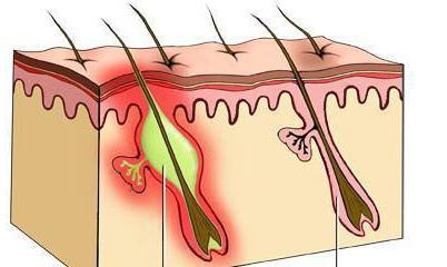 фурункул на ноге 