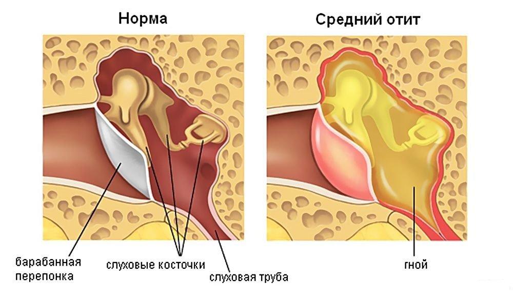 хронический отит симптомы