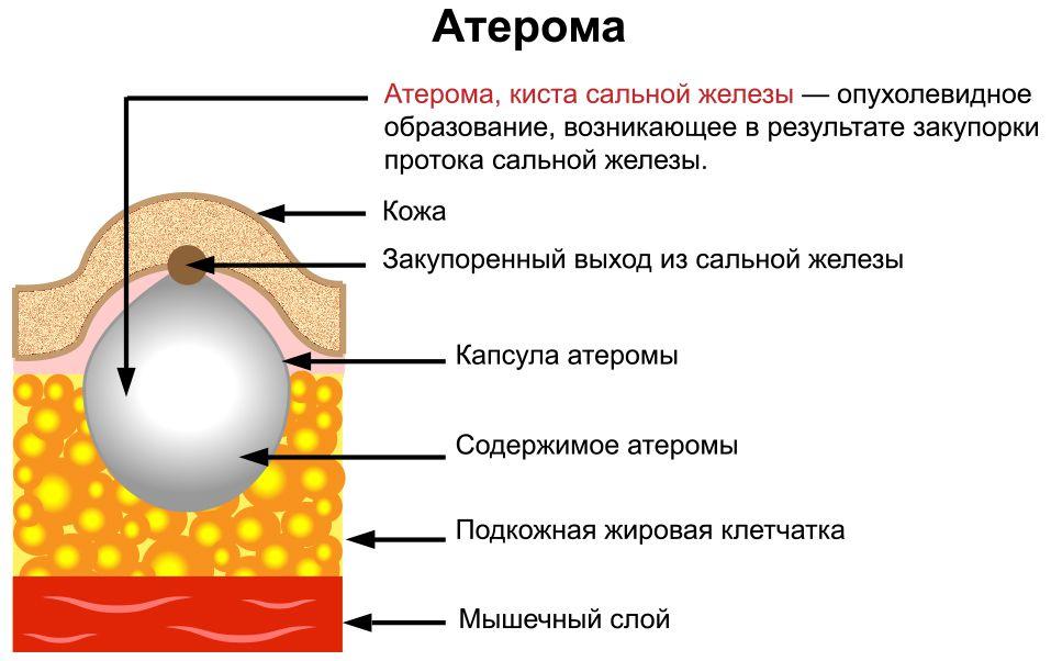 закупорка сальной железы