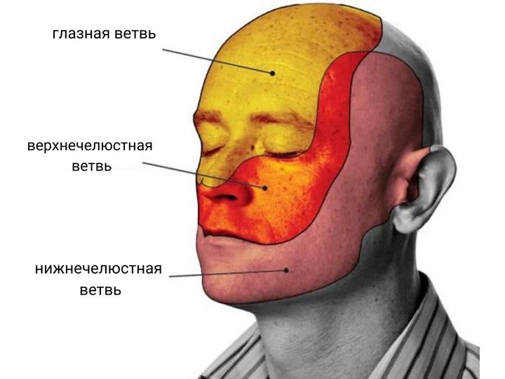 лечение невралгии