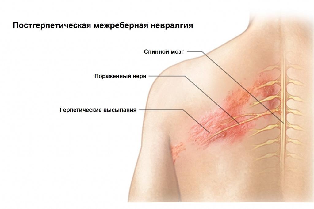 лечение невралгии