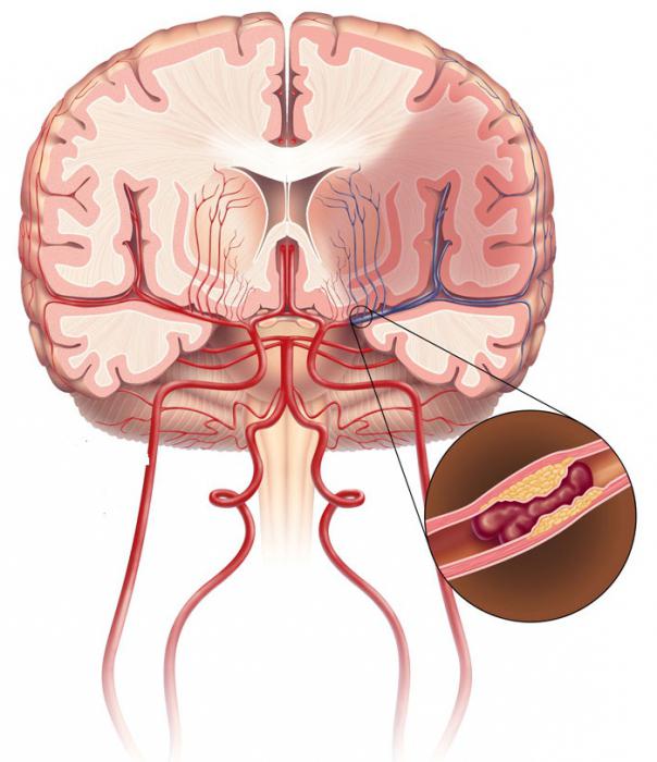 атеросклероз церебральных сосудов