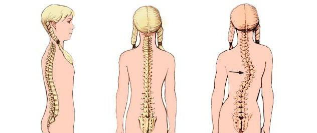 поясничный сколиоз