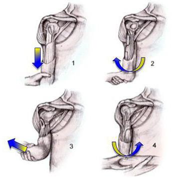  как вправлять плечо