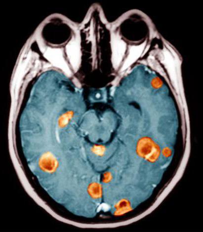 последняя стадия рака мозга