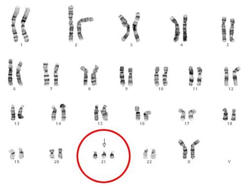 трисомия 21 нормальные показатели
