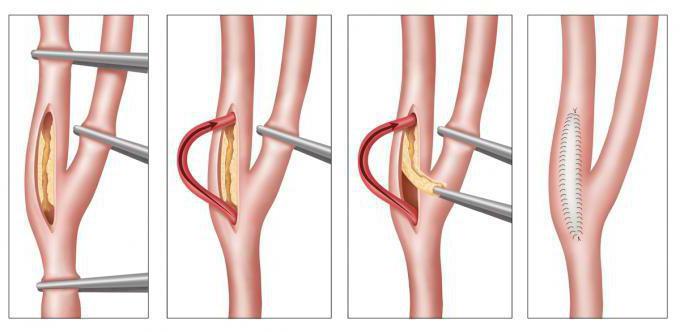 операция каротидная эндартерэктомия
