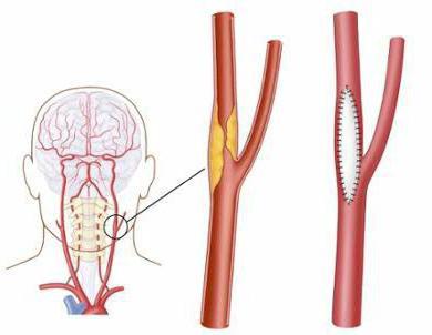 каротидная эндартерэктомия