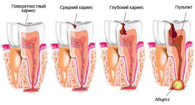 признаки глубокого кариеса