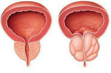 диагностика простатит 