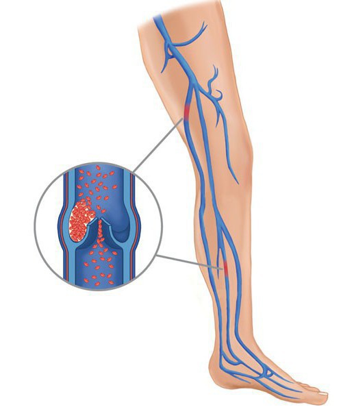 тромбоэмболия вен нижних конечностей