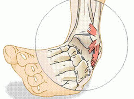 растяжение связок голеностопного сустава лечение