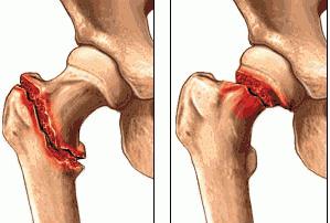 как лечить перелом шейки бедра