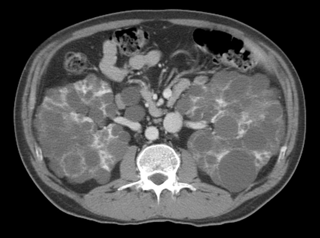 Диагностика поликистоза почек