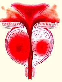 первые симптомы простатита у мужчин