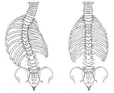 юношеский идиопатический сколиоз 