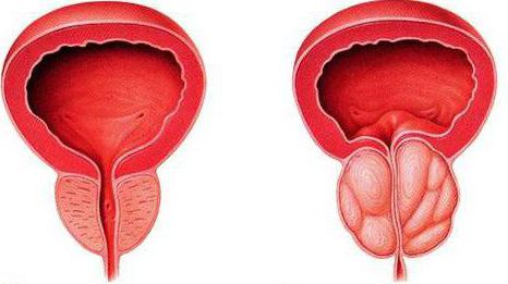 хронический конгестивный простатит