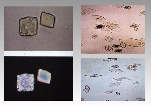 кристаллы кальция в моче