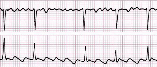 трепетание предсердий на экг