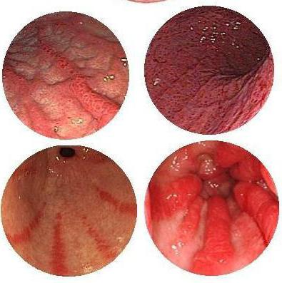 диагностика острого гастрита