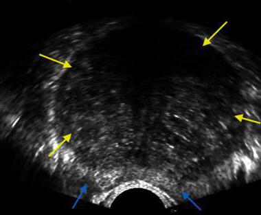 трансректальное узи мочевого пузыря