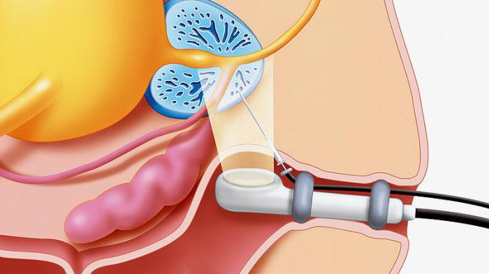 трансректальное узи простаты