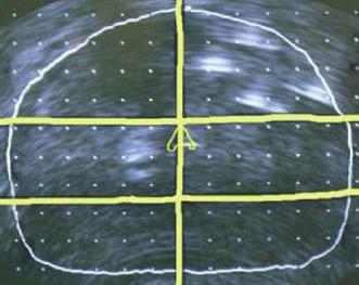 трансректальное узи подготовка