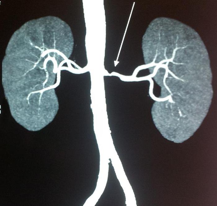 стеноз левой почечной артерии