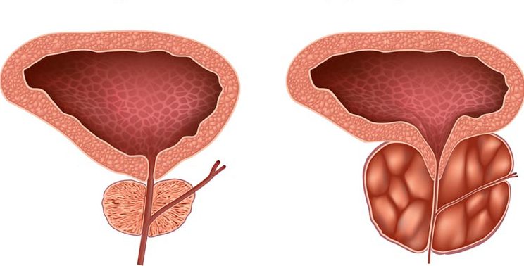 как проверить аденому простаты