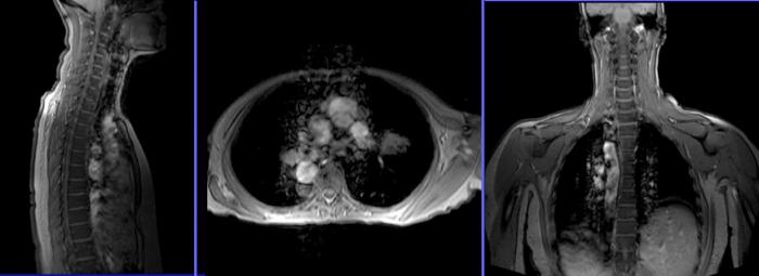 мрт грудного отдела позвоночника 