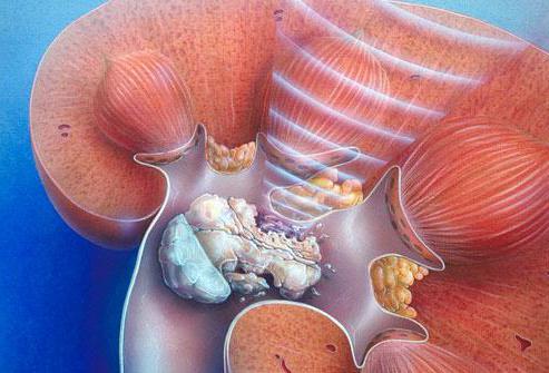 мочекаменная болезнь почек у мужчин ее лечение