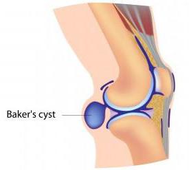 синовиальная киста сустава