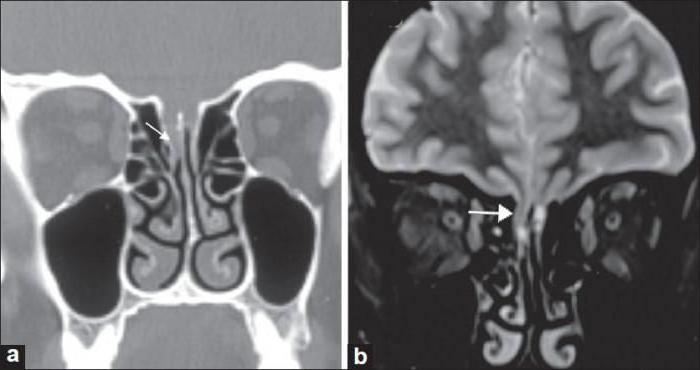 ликворея назальная