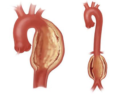 аневризма аорты сердца что это такое