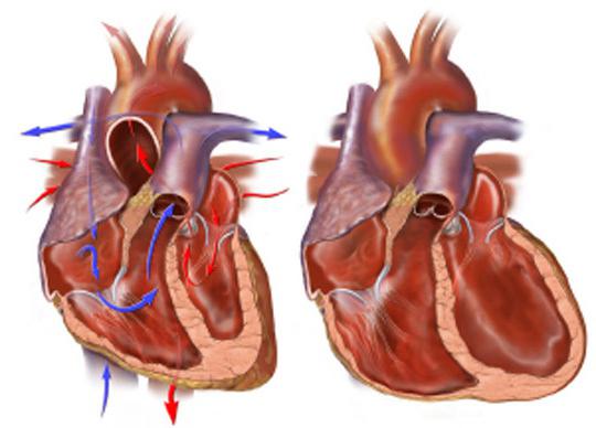 левожелудочковая недостаточность